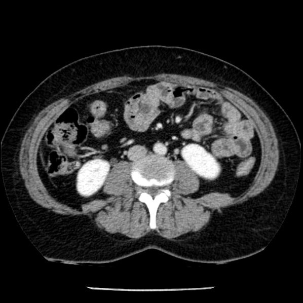 Adrenal myelolipoma (Radiopaedia 43401-46759 Axial C+ portal venous phase 47).jpg