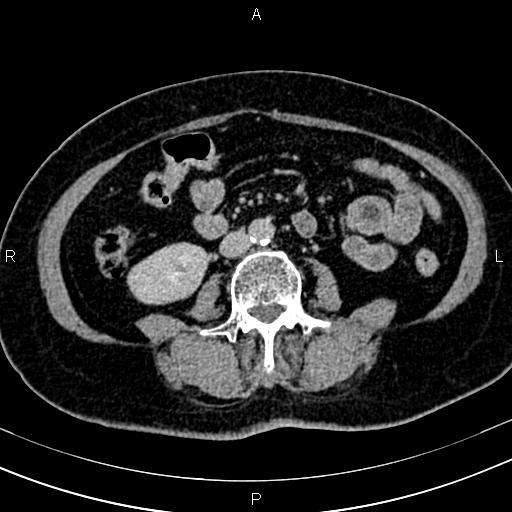 Adrenal myelolipoma (Radiopaedia 82742-96986 Axial renal excretory phase 85).jpg
