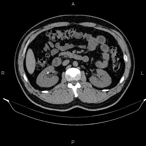 Adrenal myelolipoma (Radiopaedia 84321-99619 Axial non-contrast 48).jpg
