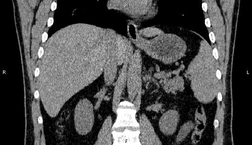 Adrenal myelolipoma (Radiopaedia 84321-99619 Coronal non-contrast 46).jpg
