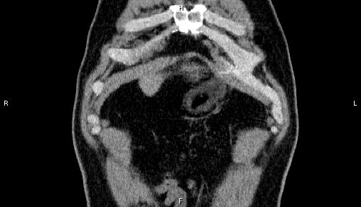 File:Adrenal myelolipoma (Radiopaedia 84321-99619 Coronal non-contrast 5).jpg