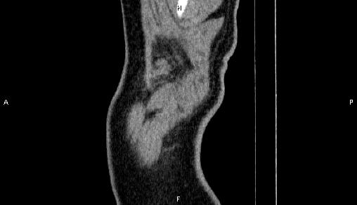 Adrenal myelolipoma (Radiopaedia 84321-99619 Sagittal non-contrast 1).jpg
