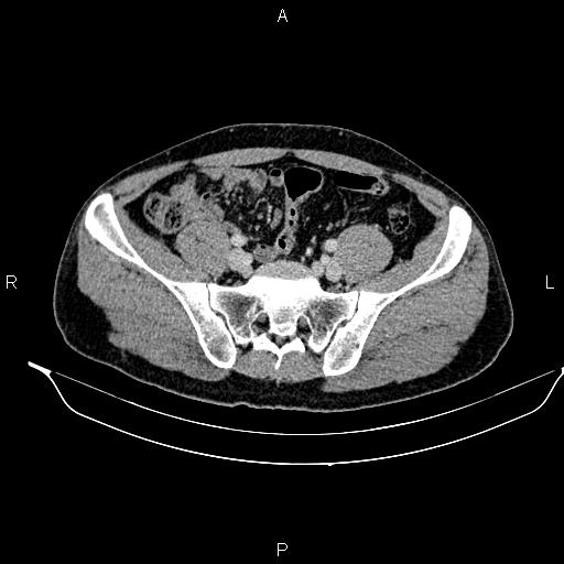 Adrenal myelolipoma (Radiopaedia 87794-104246 Axial renal cortical phase 81).jpg