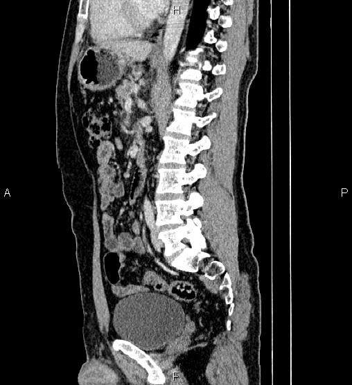 Adrenal myelolipoma (Radiopaedia 87794-104246 Sagittal renal cortical phase 54).jpg