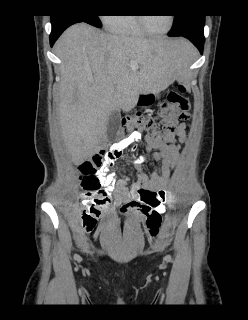 Adrenal myelolipoma - bilateral (Radiopaedia 74805-85810 Coronal C+ portal venous phase 206).jpg