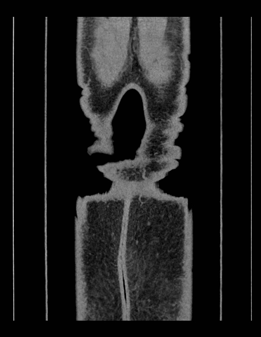 Adrenal myelolipoma - bilateral (Radiopaedia 74805-85810 Coronal C+ portal venous phase 30).jpg