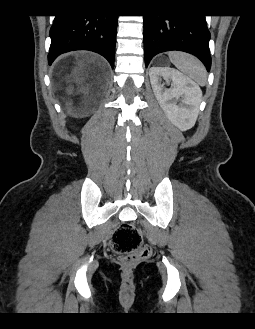 Adrenal myelolipoma - bilateral (Radiopaedia 74805-85810 Coronal C+ portal venous phase 89).jpg