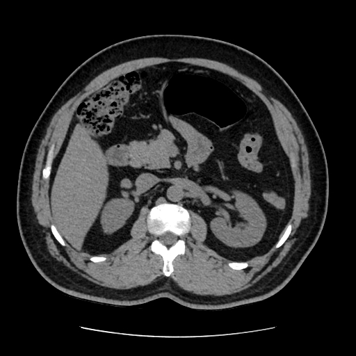 Adrenal myelolipoma and beaver tail liver (Radiopaedia 86201-102193 Axial non-contrast 182).jpg