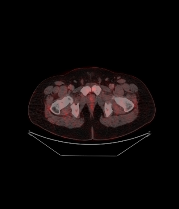 Adrenocortical carcinoma (Radiopaedia 80134-93440 ِAxial 256).jpg