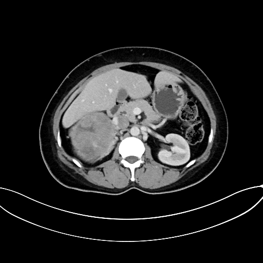 Adrenocortical carcinoma (Radiopaedia 87281-103569 Axial C+ portal venous phase 35).jpg