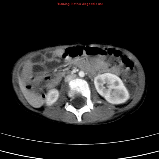 File:Adrenocortical carcinoma (Radiopaedia 9449-10131 Axial C+ portal venous phase 29).jpg
