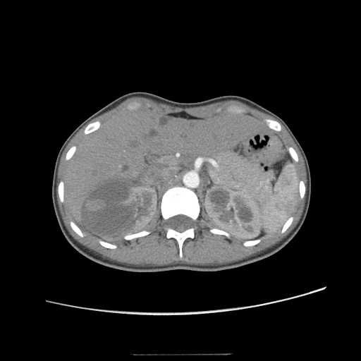 Adult polycystic kidney disease (Radiopaedia 48845-53876 Axial renal cortical phase 13).jpg