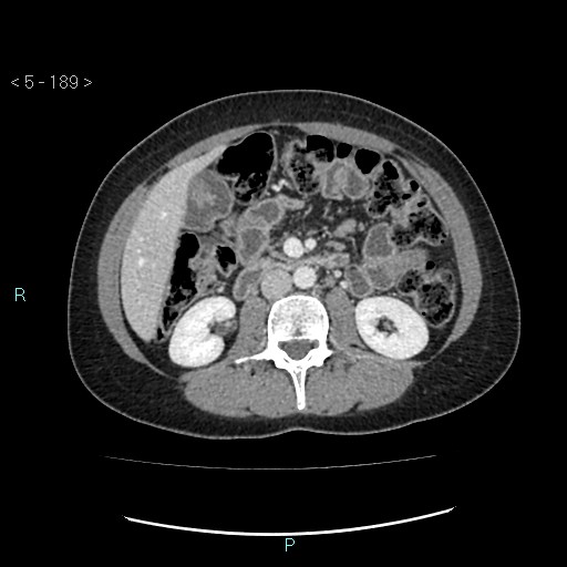 Adult transient intestinal intussusception (Radiopaedia 34853-36310 Axial C+ portal venous phase 32).jpg