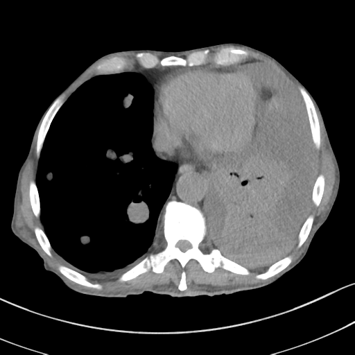 Advanced metastatic lung cancer (Radiopaedia 48910-53954 Axial non-contrast 45).png