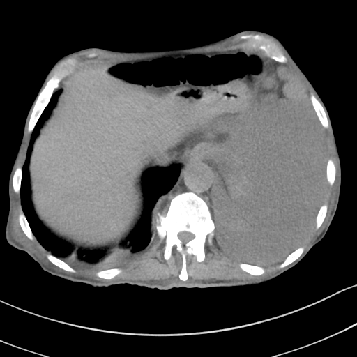 Advanced metastatic lung cancer (Radiopaedia 48910-53954 Axial non-contrast 55).png