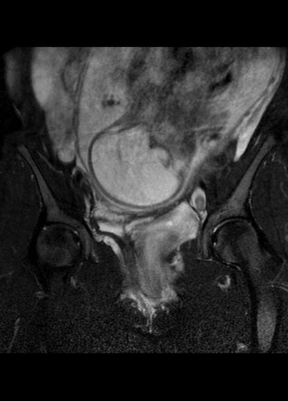 File:Aggressive angiomyxoma of the pelvis and perineum (Radiopaedia 59162-66479 Coronal T2 fat sat 11).jpg