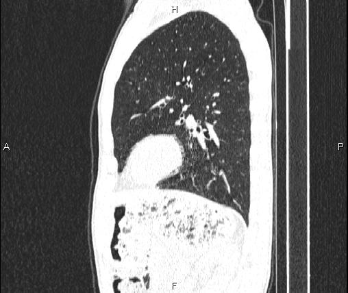 Air bronchogram in pneumonia (Radiopaedia 85719-101512 Sagittal lung window 71).jpg