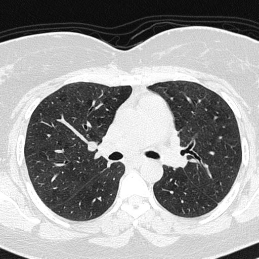 File:Air trapping in small airway disease (Radiopaedia 61685-69694 Axial lung window 73).jpg