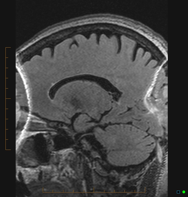 Aliasing artifact causing a spurious cerebellar lesion (Radiopaedia 48783-53810 Sagittal FLAIR 19).jpg