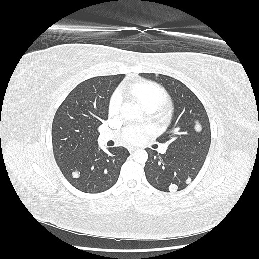 Alveolar soft part sarcoma - right leg (Radiopaedia 59432-67091 Axial lung window 53).jpg
