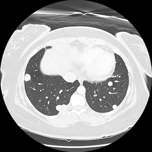 Alveolar soft part sarcoma - right leg (Radiopaedia 59432-67091 Axial lung window 85).jpg