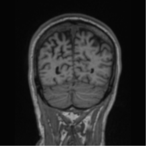 File:Alzheimer's disease- with apraxia (Radiopaedia 54763-61011 Coronal T1 23).png