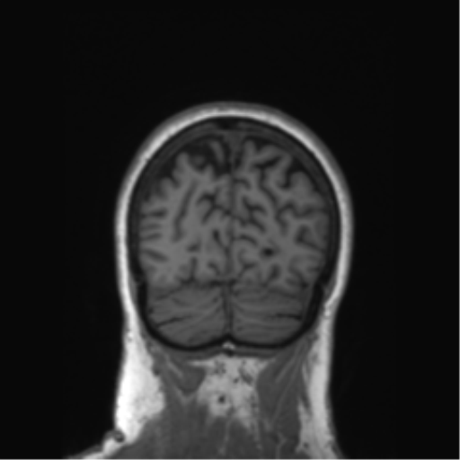 Alzheimer's disease (Radiopaedia 42658-45802 Coronal T1 44).png