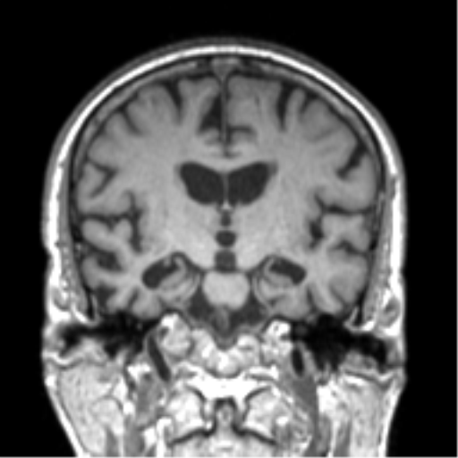 Alzheimer disease and cerebral amyloid angiopathy (Radiopaedia 64234-73011 Coronal T1 33).png
