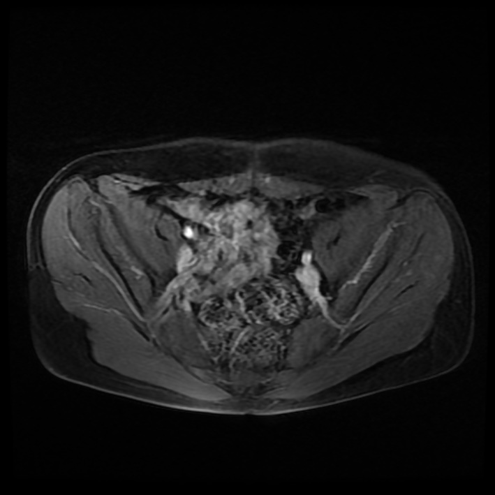 Ambiguous genitalia (Radiopaedia 69686-79643 Axial T1 C+ fat sat 17).jpg