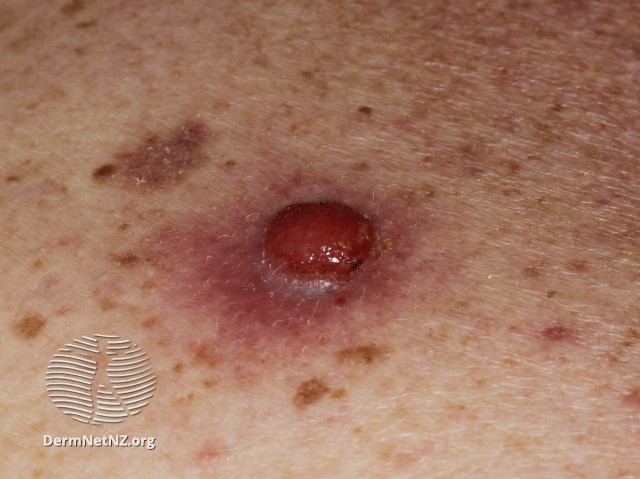 File:Amelanotic nodular melanoma (DermNet NZ amelanotic-melanoma2).jpg