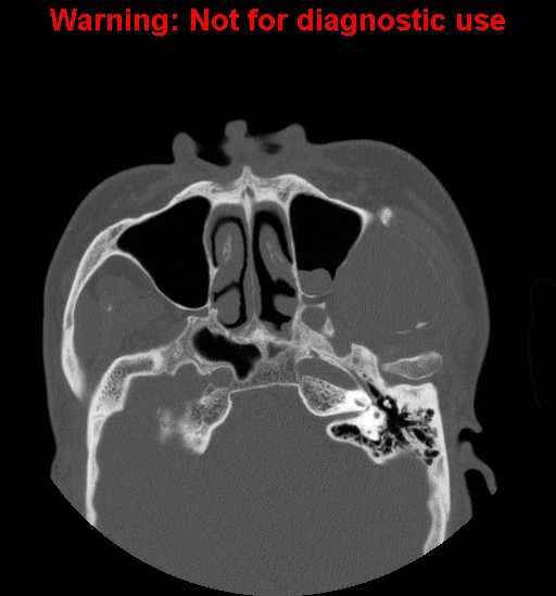 File:Ameloblastoma (Radiopaedia 13276-13280 Axial non-contrast 20).jpg