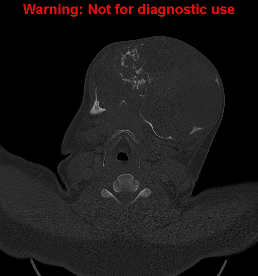 File:Ameloblastoma (Radiopaedia 33126-34164 Axial bone window 24).jpg