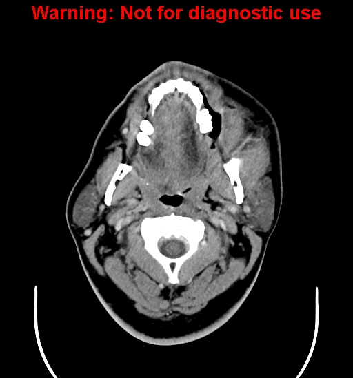 File:Ameloblastoma (Radiopaedia 33126-34164 B 4).jpg