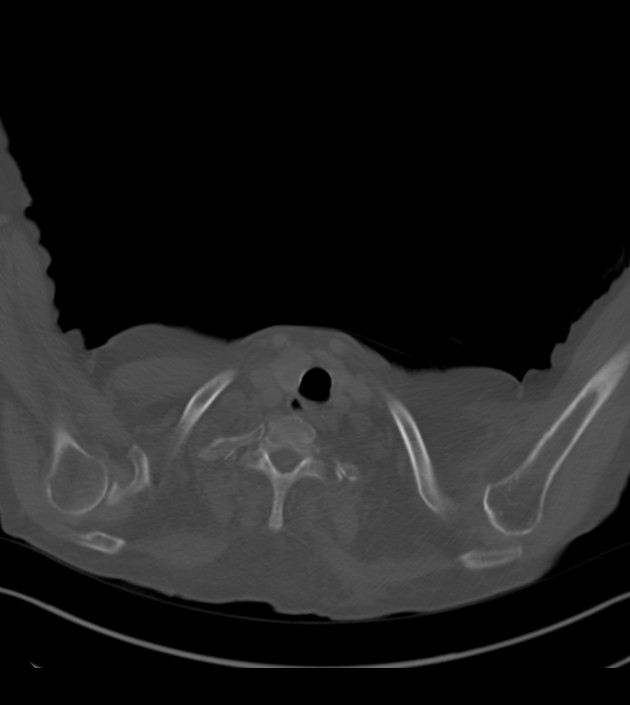 Amiodarone deposition in the liver (Radiopaedia 77587-89780 Axial bone window 3).jpg