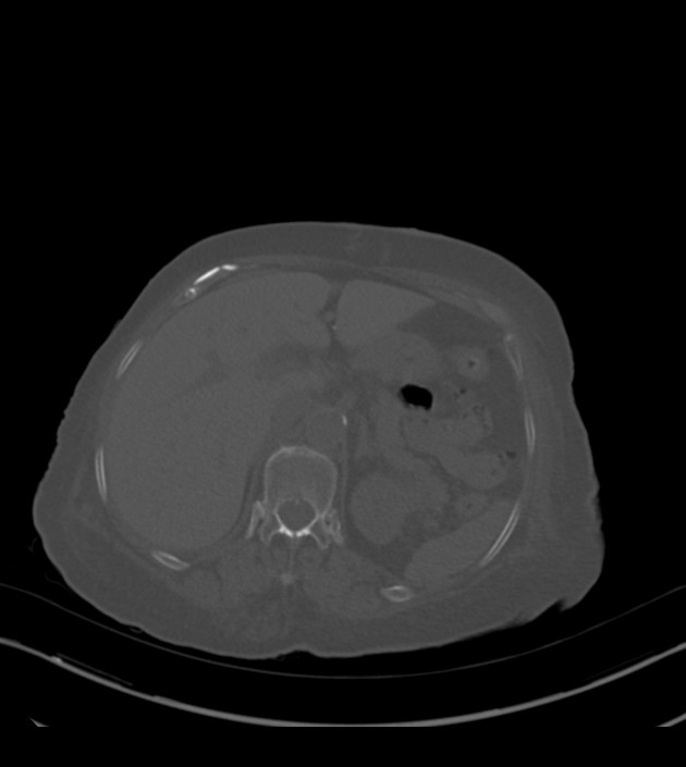 Amiodarone deposition in the liver (Radiopaedia 77587-89780 Axial bone window 84).jpg