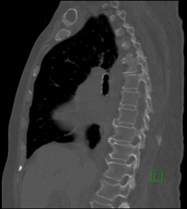 Amiodarone deposition in the liver (Radiopaedia 77587-89780 Sagittal bone window 58).jpg