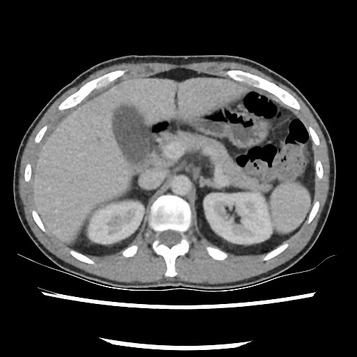 Amoebic liver abscesses (Radiopaedia 55536-62010 A 31).jpg