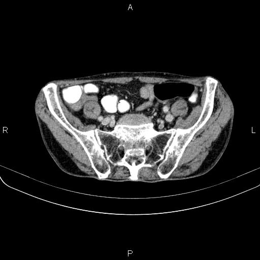 Ampullary adenocarcinoma (Radiopaedia 86093-102033 B 93).jpg
