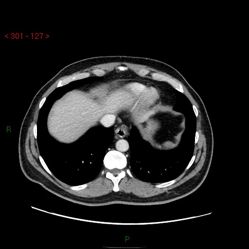 Ampullary carcinoma (Radiopaedia 56396-63056 C 12).jpg