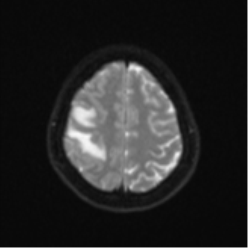 Anaplastic astroblastoma (Radiopaedia 55666-62194 Axial DWI 23).png