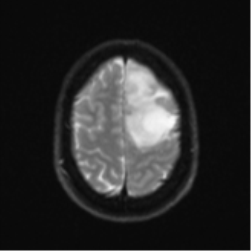 Anaplastic astrocytoma (Radiopaedia 57768-64731 Axial DWI 24).png