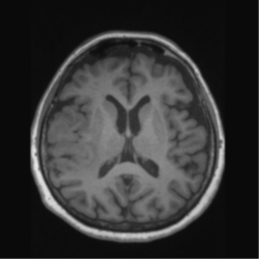 File:Anaplastic astrocytoma IDH wild-type (pseudoprogression) (Radiopaedia 42209-45276 Axial T1 87).png