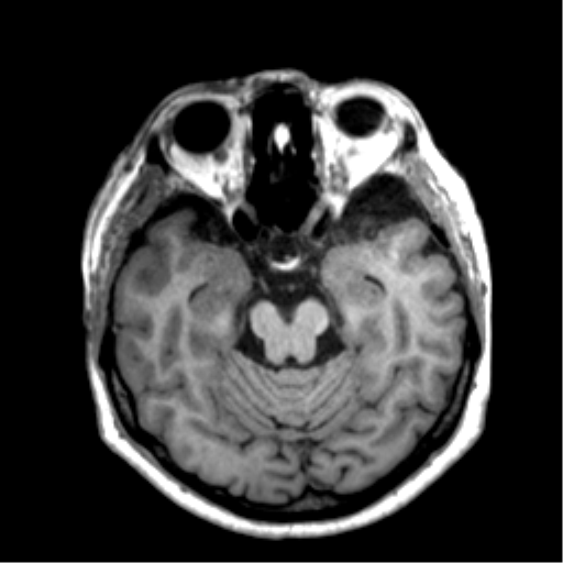 Anaplastic astrocytoma IDH wild-type (pseudoprogression) (Radiopaedia 42209-45277 Axial T1 48).png