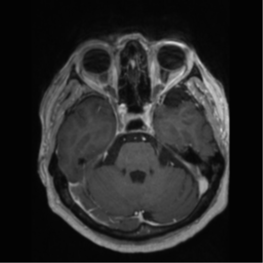File:Anaplastic astrocytoma IDH wild-type (pseudoprogression) (Radiopaedia 42209-45277 Axial T1 C+ 36).png