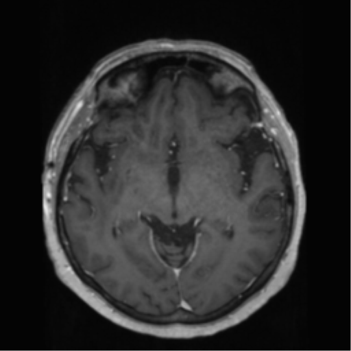 File:Anaplastic astrocytoma IDH wild-type (pseudoprogression) (Radiopaedia 42209-45278 Axial T1 C+ 74).png