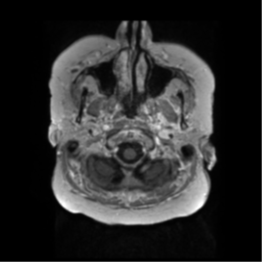 File:Anaplastic astrocytoma IDH wild-type (pseudoprogression) (Radiopaedia 42209-45279 Axial T1 C+ 12).png
