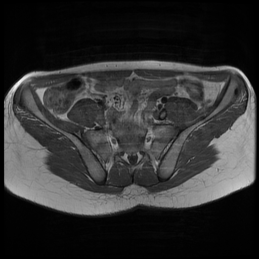 File:Androgen insensitivity syndrome (Radiopaedia 38585-40727 Axial T1 3).jpg