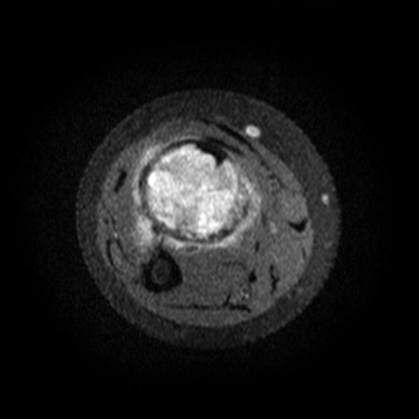 File:Aneurysmal bone cyst - radius (Radiopaedia 5866-7442 Axial PD fat sat 1).jpg