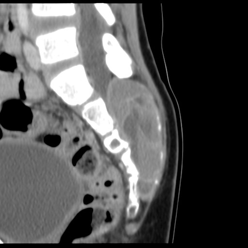 File:Aneurysmal bone cyst - sacrum (Radiopaedia 65190-74195 A 13).jpg