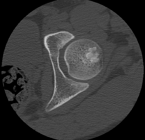 Aneurysmal bone cyst of ischium (Radiopaedia 25957-26094 B 5).png